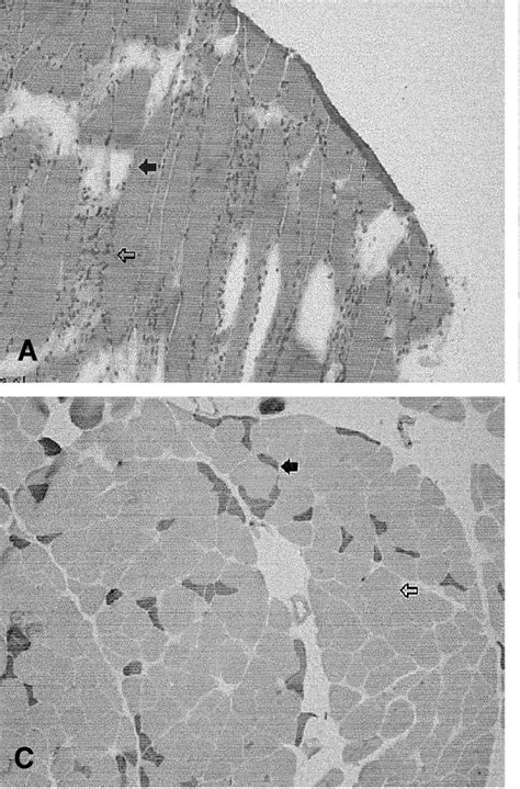 [PDF] A case of steroid induced myopathy and peripheral polyneuropathy ...