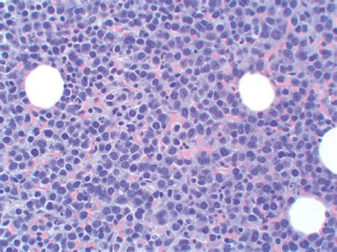 Bone Marrow Clot Section Containing Approximately 80 Plasmacytoid