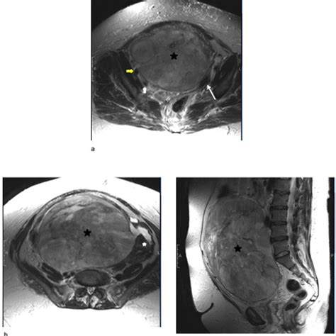 A Axial T2 Weighted Mri Of Pelvis Demonstrates A Bulky Download Scientific Diagram