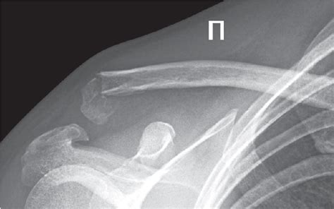 Figure 1 From Coracoid Process Fracture Associated With A Distal Clavicle Fracture A Case