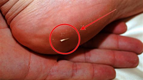 How to remove a splinter easily? - YouTube