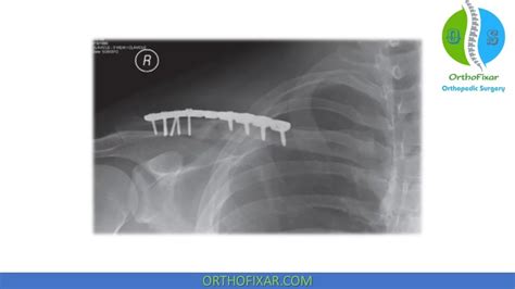 Clavicle Fractures Orthofixar