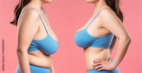 Before And After Breast Augmentation Concept Woman With Very Large