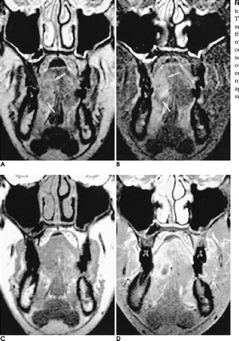 Figure 1 From Fast Spin Echo T2 Weighted MR Imaging Of Tongue Cancer