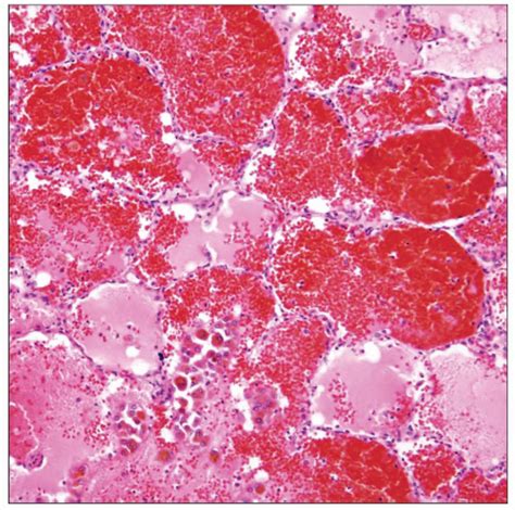 Idiopathic Pulmonary Hemosiderosis Basicmedical Key