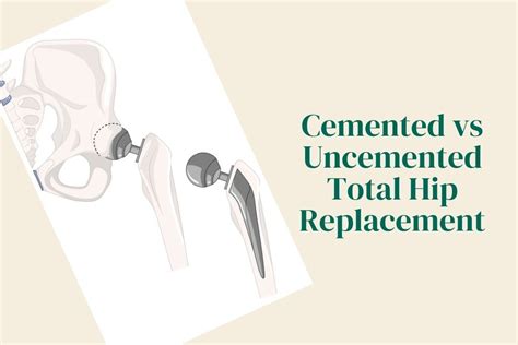 Know More About Cemented Vs Uncemented Hip Replacement