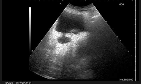 Bladder Diverticulum Ultrasound