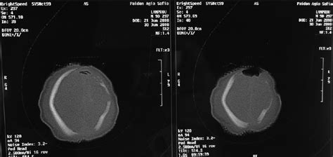 Aplasia Cutis Congenita Two Case Reports And Discussion Of The