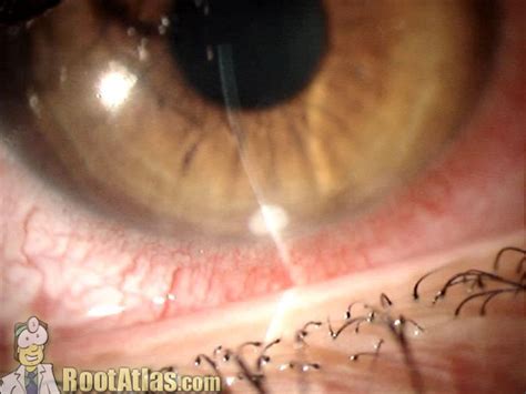 Staphylococcal Marginal Keratitis