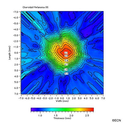 Case 8 3D Ultrasound Topography Of Choroidal Melanoma New York Eye