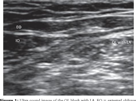 Figure 1 From Ultrasound Guided Quadratus Lumborum Block Or Posterior