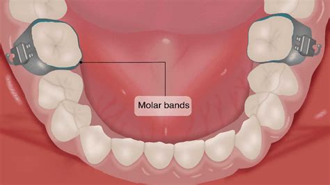 Molar Bands With Cleats In Orthodontics Takeaways For