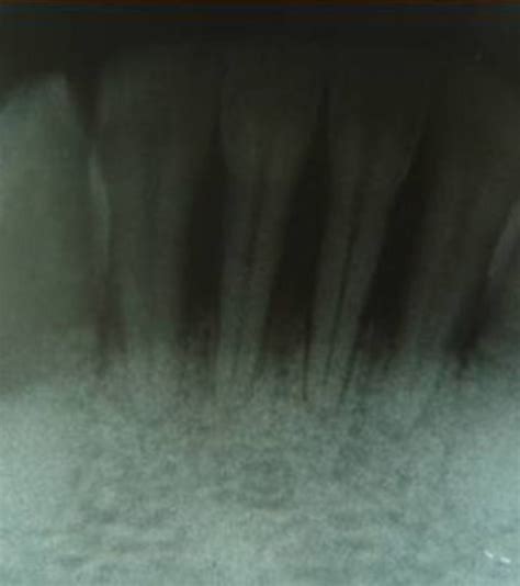 Intra Oral Peri Apical Radiographic View Showing Horizontal Bone Loss