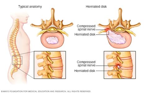 Herniated Disc Oaklawn Hospital