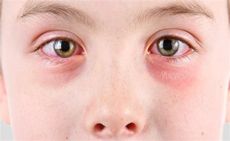 Conjuntivitis en niños y adultos Clínica Internacional