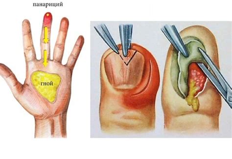 A modern method of treating panaritium in Tashkent i