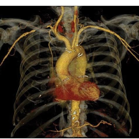 Same Case As Figure 3 Volume Rendering Technique VRT Demonstrates