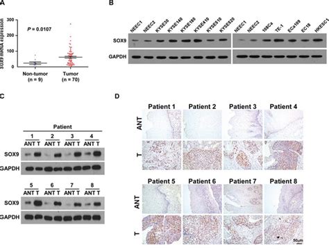 Upregulation Of Sex Determining Region Y Box 9 Sox9 Promotes Cell Proliferation And