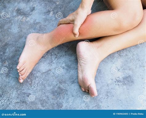 Asian Women Suffering From Leg Pain Swollen And Inflamed Legs Or Ankle