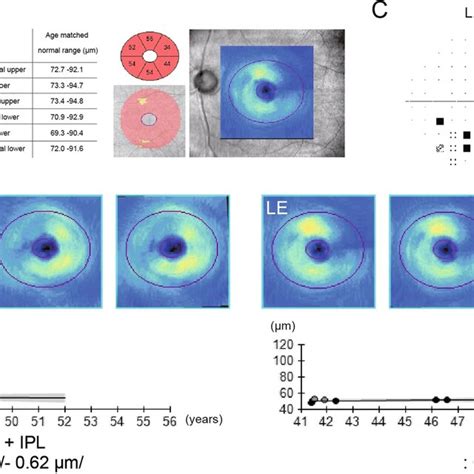 Full Field Electroretinographic Findings The Patient JU2130