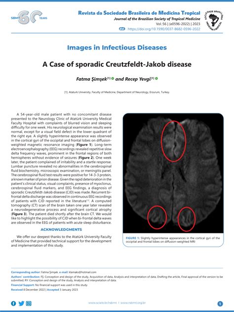 Pdf A Case Of Sporadic Creutzfeldt Jakob Disease