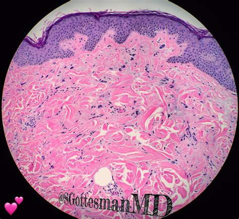 Silvija Gottesman Md On Twitter Pleomorphic Fibroma Beauty In