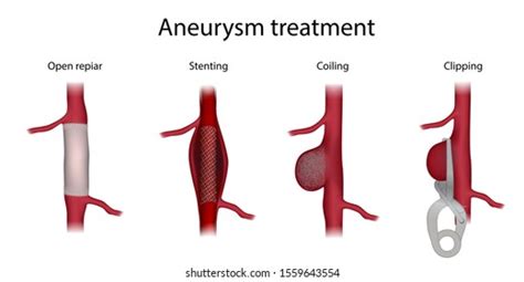 Aneurysm Images, Stock Photos & Vectors | Shutterstock