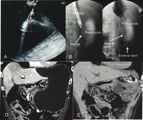 EUS-drainage for pancreatic pseudocyst | Download Scientific Diagram