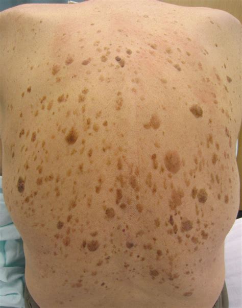 Seborrheic Keratosis Lesions Hot Sex Picture