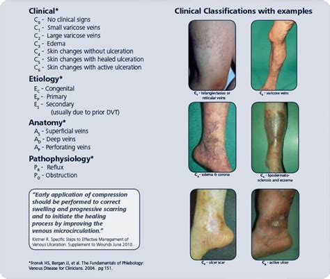 Reticular Veins Chest