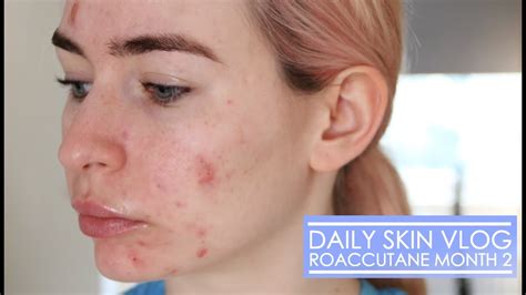 Roaccutane Daily Skin Vlog Month 2 Youtube