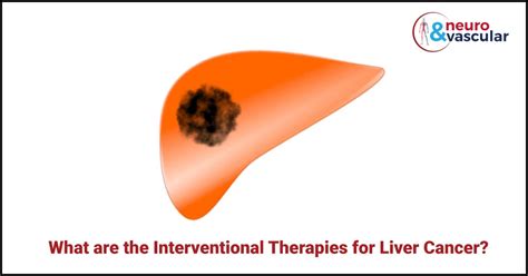 What Are The Interventional Therapies For Liver Cancer Drsuresh Medium