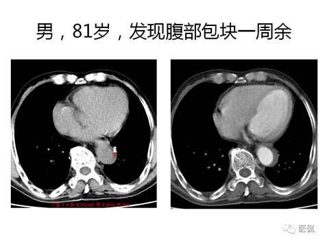 主动脉夹层的影像诊断，这样鉴别更简单！ 好医术早读文章 好医术 赋能医生守护生命