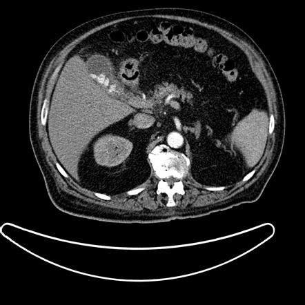 Hepatic Abscess And Hepatic Vein Thrombosis Related To Acute