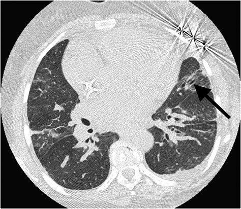 Manifestations Of Sickle Cell Disease On Thoracic Imaging Clinical