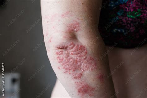 Psoriasis skin. Psoriasis is an autoimmune disease that affects the ...