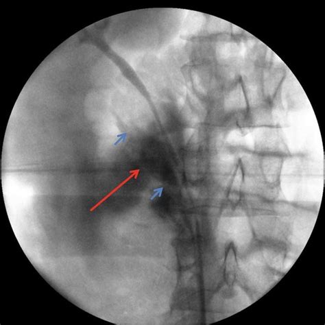 MAG 3 Renogram indicating slightly asymmetrical renal function (left ...