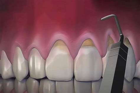 Chao Pinhole Gum Rejuvenation Treatment Nuffield Dental