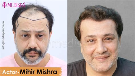 Bollywood Actor Mihir Mishra Hair Transplant Results