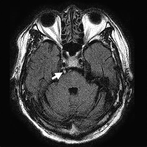 Basilar Artery Mri