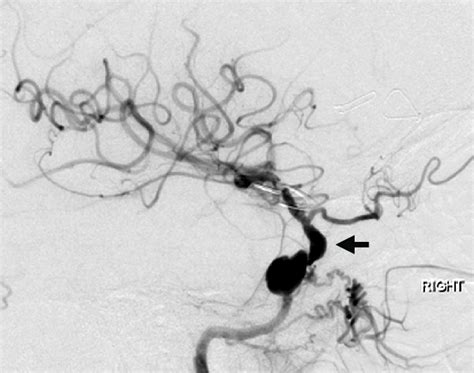 Lateral Right Common Carotid Arteriogram A Saccular Aneurysm Is Download Scientific Diagram