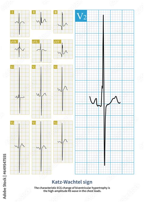 A Year Old Male Patient Was Clinically Diagnosed With Atrial Septal