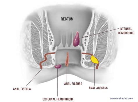 Anal Fistula Treatment In Homeopathy