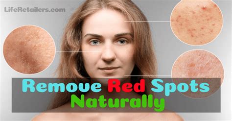 How To Remove Or Get Rid Of Red Spots On The Skin Naturally Life Retailers