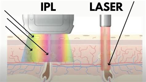 The Difference Between Ipl And Laser Hair Removal And How To Choose