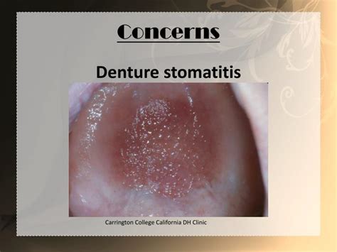 Ppt Denture Stomatitis Powerpoint Presentation Id2034905