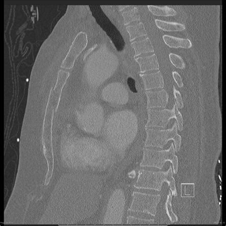 Sternal Fracture Radiology Reference Article Radiopaedia Org