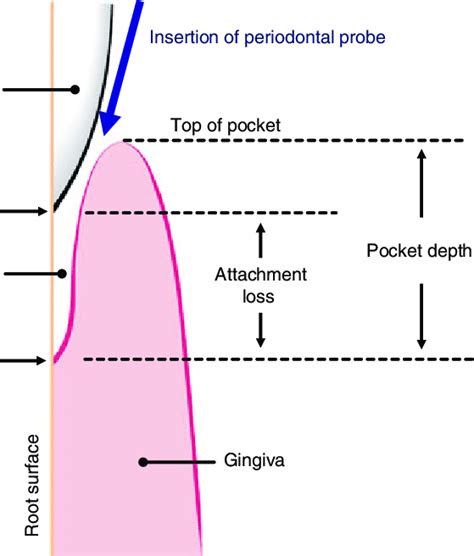 Periodontal Probe Measurements