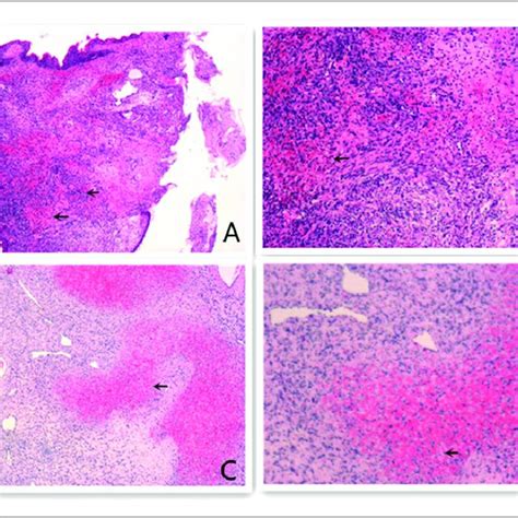 A Histopathology Features Of Biopsy Specimen Hematoxylin And Eosin