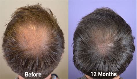 Finasteride Results 3 Months